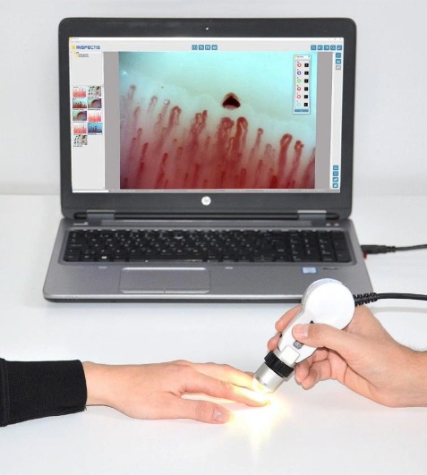 Nail Fold Capillaroscopy