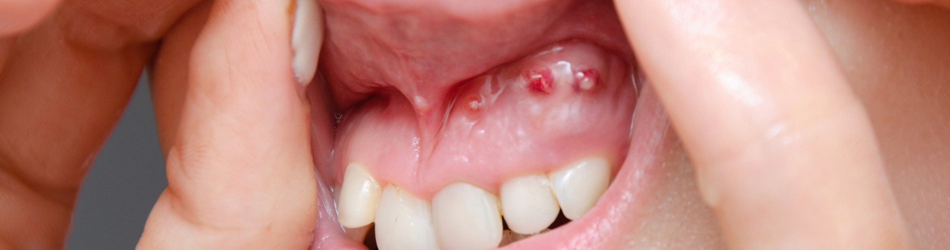 Cyst & Tumours of Mouth & Jaw