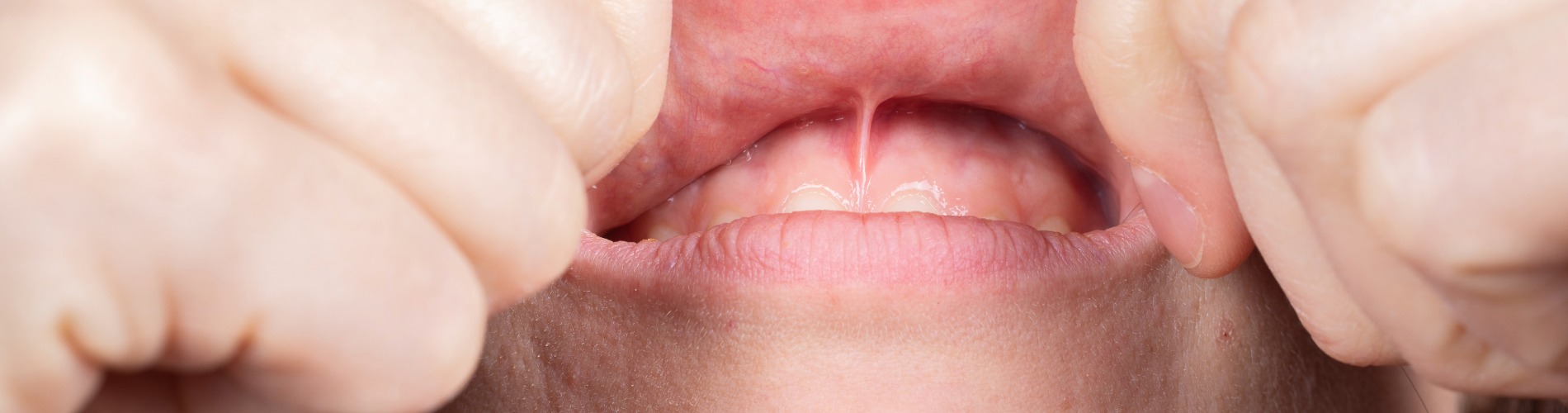 Laser Assisted Soft Tissue Surgery